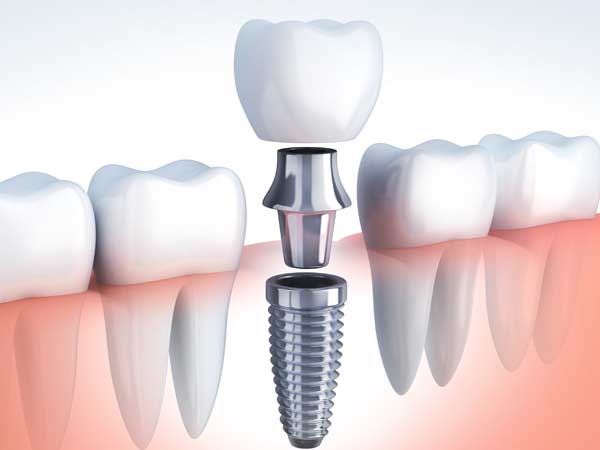Implant tooth